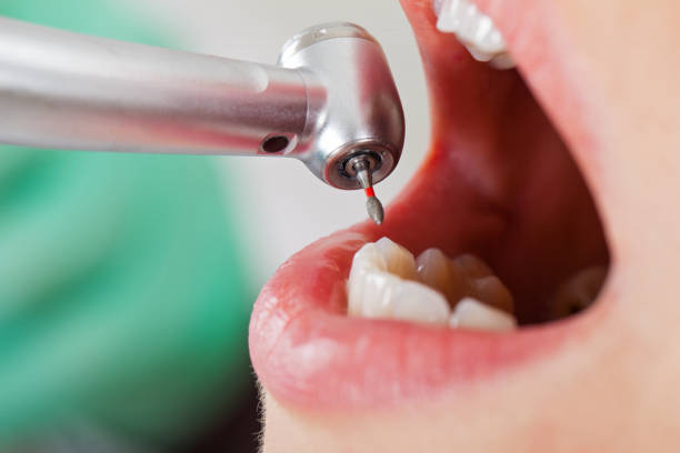 Best Emergency Treatment for Dental Infections or Abscesses in Shady Hollow, TX